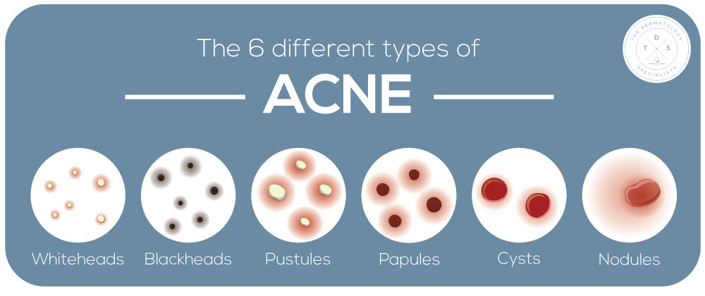 मुहासों pimples types