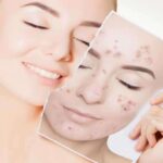 मुहासों, Pimples