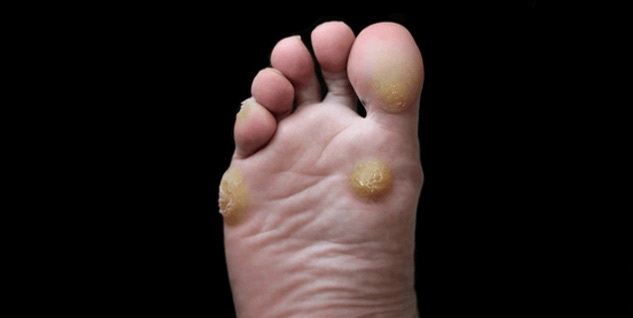 Foot Corn (गोखरू/पैरों के कील)